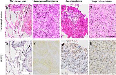 Aberrant Expression of Cardiac Troponin-T in Lung Cancer Tissues in Association With Pathological Severity